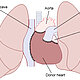 1. Herztransplantation